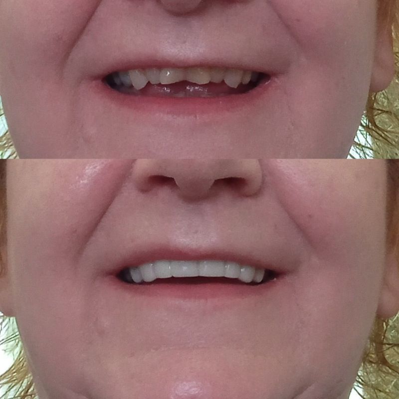 Insta Veneers - Upper + Lower